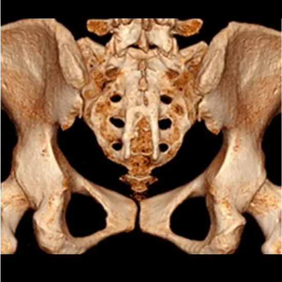 CT Sacrococcycs Spine 3D